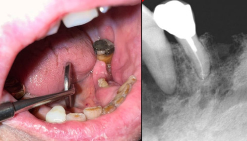 Medication Related Osteonecrosis of the Jaw 