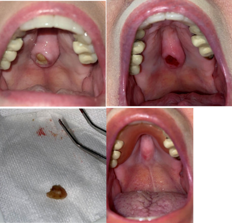 Medication Related Osteonecrosis of the Jaw 